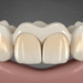 What is a Dental Crown